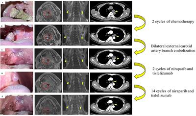 Partial response to <mark class="highlighted">niraparib</mark> in combination with tislelizumab in a patient with metastatic undifferentiated tonsillar carcinoma: a case report and literature review